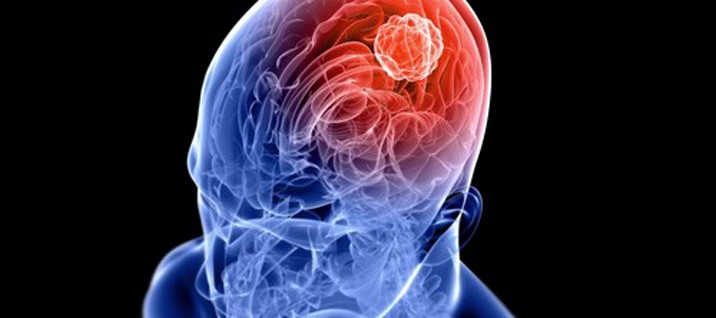 2018 Gamma Knife/Neuro Oncology Tumor Board (Occurs Weekly, Every Friday) Banner